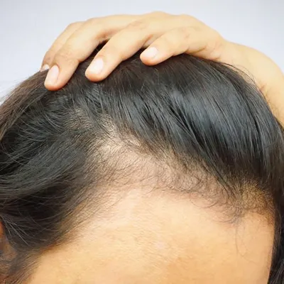 Алопеция (выпадение волос): причины, диагностика и цены на лечение в  клинике Universum Clinic