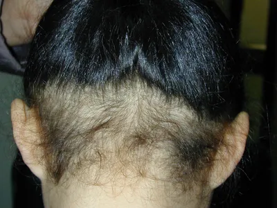 Диффузное выпадение волос фото фотографии