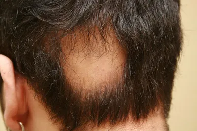 Выпадают волосы: что делать, как лечить, причины выпадения волос