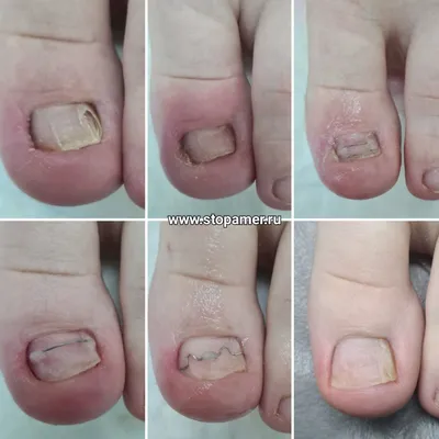 Лечение, удаление вросшего ногтя без хирургии — Центр подологии в СТОПАМЕР  СПБ