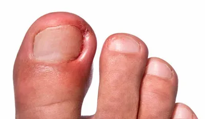 Что такое дикое мясо возле ногтя на руке и на ноге? Как лечить дикое мясо  на ногте народными средствами, чистотелом, лазером?
