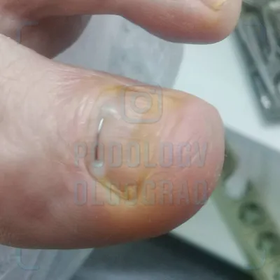 Удаление вросшего ногтя у хирурга в Ростове-на-Дону