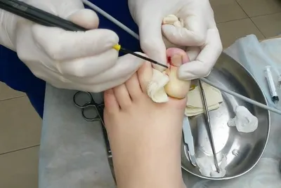 Удаление вросшего ногтя в Москве|Стоимость операции в клинике|удалить  вросший ноготь по низкой цене