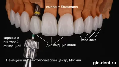 Коронки из диоксида циркония (в том числе на имплантах) для протезирования  жевательных зубов
