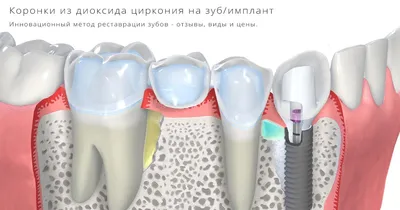 Коронки из диоксида циркония в Оренбурге по цене 14 000 ₽ | Гарантия |  стоматология Вита-Дент
