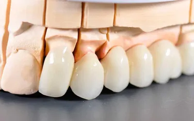Диоксид циркония - преимущества использования в стоматологии
