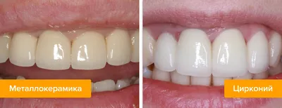 Статья о стоматологии: Диоксид циркония. Прочность и эстетика  ортопедических конструкций