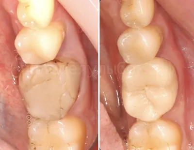 Зубные коронки из циркония (безметалловые) - «Я расскажу, почему я  отказалась от металлокерамических коронок во второе протезирование спустя  11 лет. Почему я советую переплатить и поставить коронки из диоксида  циркония. Особенно на