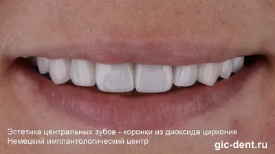Коронки и мосты на основе диоксида циркония в Азове - Цены в  стоматологической клинике \"Дента\"