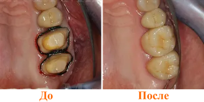Коронки из диоксида циркония в Сочи: цены и показания