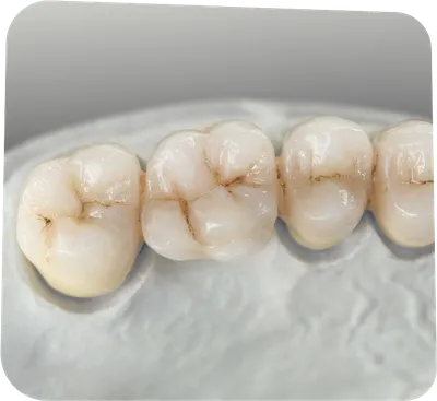 Тотальное протезирование безметалловыми коронками из диоксида циркония и  виниры E-max при стираемости зубов