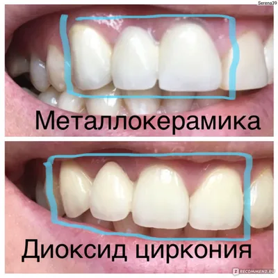 Коронки из диоксида циркония (в том числе на имплантах) для протезирования  жевательных зубов