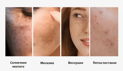 Псориаз, 3 недели терапии. Поствоспалительная дисхромия (пятна) кожи уйдёт  самостоятельно через 3-4 месяца без дополнительного лечения. | Instagram