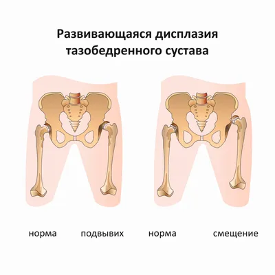 Дисплазия: что это такое, симптомы, признаки, лечение, виды
