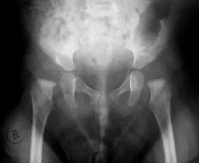 Дисплазия тазобедренного сустава у детей фото рентген фотографии