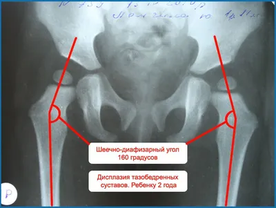 Дисплазия тазобедренных суставов | Bowlegs