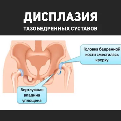 Ацетабулярный угол / индекс - норма у детей до 1 года