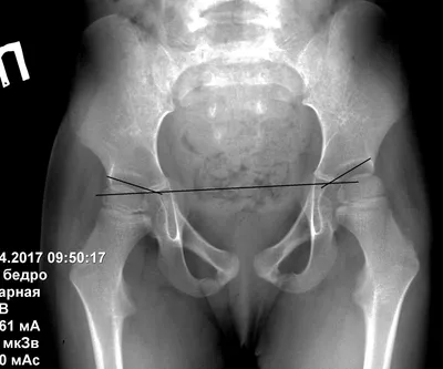 Дисплазия тазобедренных суставов у ребенка №3 - Galen orto - «Доктор Гален»  консультация ортопеда, травматолога, ревматолога. Обследование. Лечение.  Медицинские изделия.