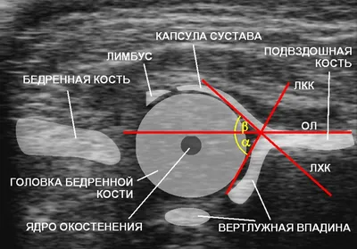 Лечение Дисплазия тазобедренного сустава и врожденный вывих бедра -  Ортопедия Руслана Сергиенко