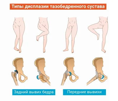 Вывихи бедренной кости в тазобедренном суставе (в т.ч. вывихи головки  эндопротеза, эндопротезирование тазобедренного сустава, перипротезные  переломы) – симптомы травмы, первая помощь и лечение, реабилитация –  Отделение травматологии НКЦ №2 (ЦКБ РАН)