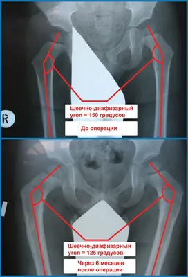 Болезнь Пертеса у детей - лечение в Минске (Беларусь) | ortoped.by