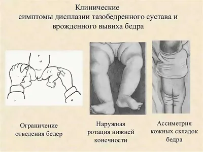 Остеотомия тазобедренного сустава при дисплазии в Москве - показания к  операции и цены