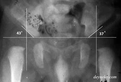 Дисплазия тазобедренных суставов | Bowlegs