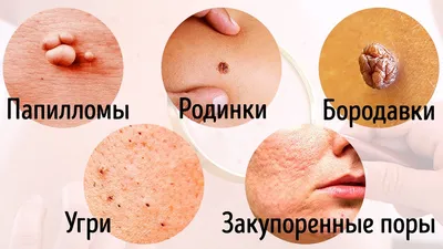 Удаление новообразований кожи лазером в Николаеве | ExtraMed
