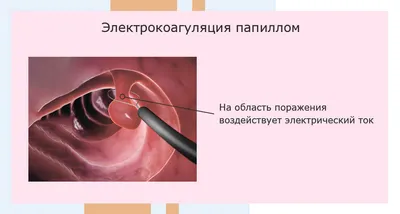 Удаление папиллом вульвы в Москве - цены в клинике АльтраВита
