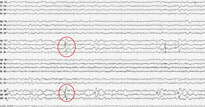 Ээг при эпилепсии фото фотографии