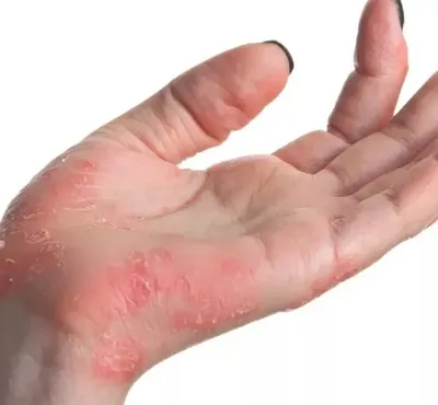 Лечение экземы: эффективные способы избавления от зуда и раздражения кожи