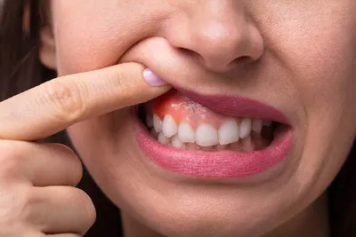ЭКЗОСТОЗ Что делать, если после удаления зуба из десны торчит что-то  острое?😱 ⁉ «Мне удалили зуб,.. | ВКонтакте