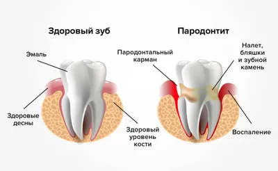 Экзостоз: причины и лечение