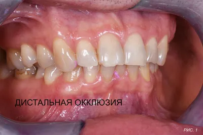 Удаление экзостоза в клинике современной стоматологии Ваш выбор в  Благовещенске