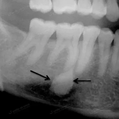 Лунка после удаления зуба мудрости - Хирургическая стоматология -  Стоматология для всех