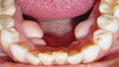 Экзостоз челюсти - симптомы, диагностика и лечение