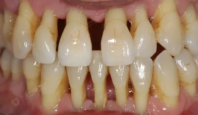 Удаление экзостозов зуба на челюсти в Москве - хирургическое лечение десны
