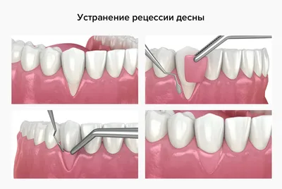 Нарост на десне: причины образования и методы лечения