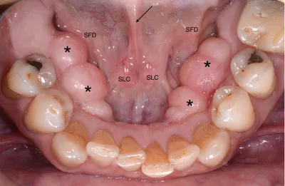Удаление экзостозов на десне в стоматологии Приоритет. Удаление экзостоза  челюсти по недорогой цене, удаление костного нароста во рту