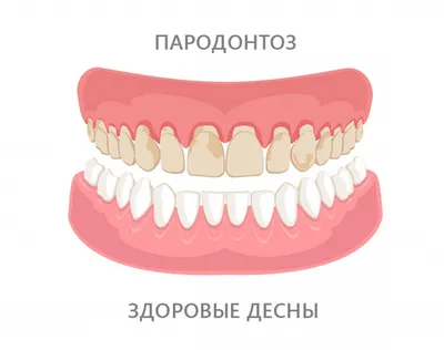 Пародонтоз у взрослых - стоимость услуги Пародонтология в стоматологии в  Киеве, Пародонтоз у взрослых - цена в стоматологии lipinskii.com.ua