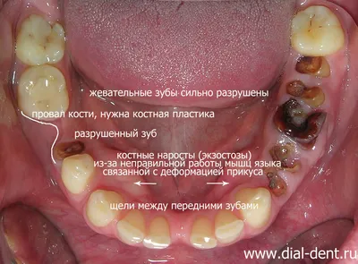 Всем привет 👋 ! Давно хотела рассказать вам про ЭКЗОСТОЗЫ. Частенько  пациенты обеспокоены тем,.. | ВКонтакте