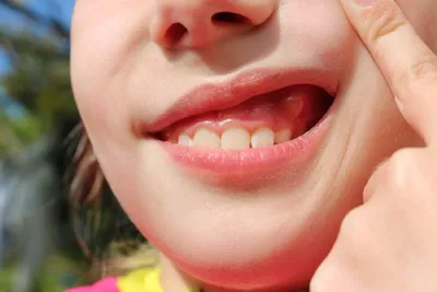 Экзостоз десны после удаления зуба 🦷 Цены на удаление экзостозов в Киеве |  CIS