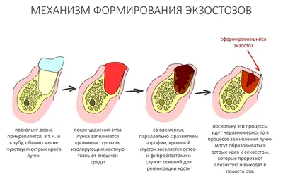 Экзостоз. Больно жевать с зубным протезом. - YouTube