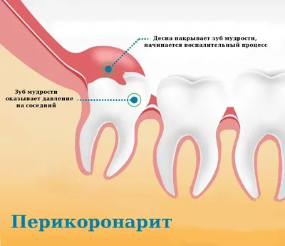 Экзостоз десны после удаления зуба 🦷 Цены на удаление экзостозов в Киеве |  CIS