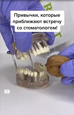 Перикоронит: удаление капюшона зуба мудрости в Москве - цена в стоматологии  «SmileLand»