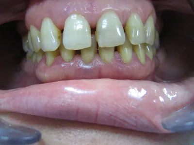 Удаление экзостозов зуба на челюсти в Москве - хирургическое лечение десны