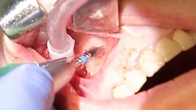 Удаление зуба в Орле — современные методы, безболезненно. Стоматология 3D