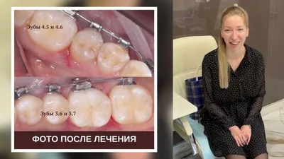 Удаление экзостоза на десне после лечения зуба в Москве