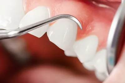 Протезирование на имплантах при полном отсутствии зубов — ROOTT