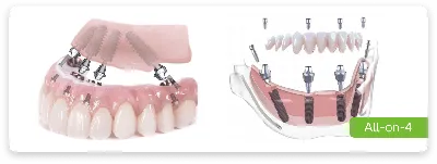 Шинирование зубов нижней челюсти с восстановлением анатомической формы  отсутствующего зуба